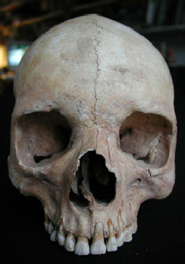 Menselijke schedel met een sutura metopica